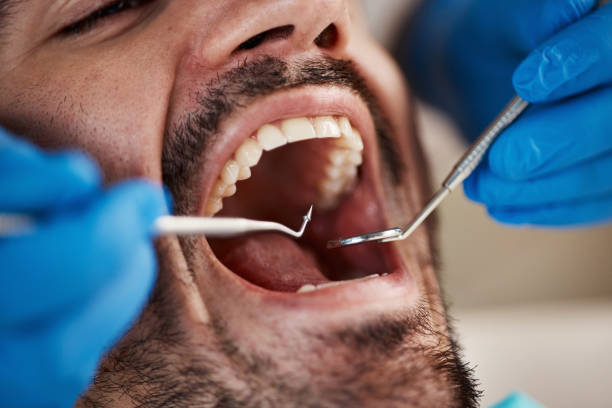 Best Emergency Wisdom Tooth Extraction in Fort Washington, MD