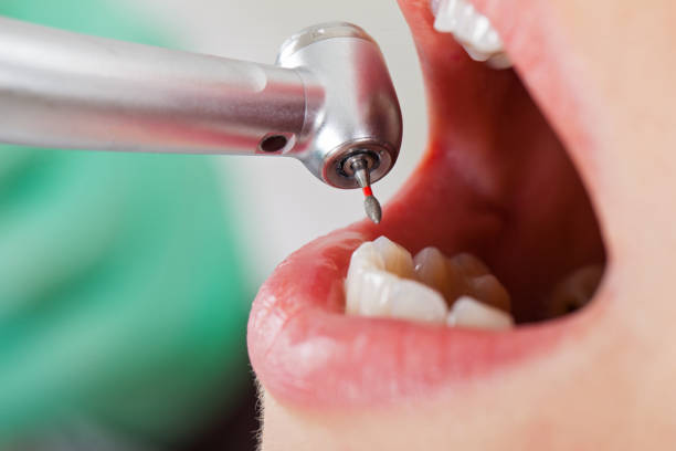 Best Emergency Wisdom Tooth Extraction in Fort Washington, MD